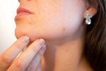 Melanoma: il 90% dei pazienti guarisce, ma salgono i casi tra i giovani